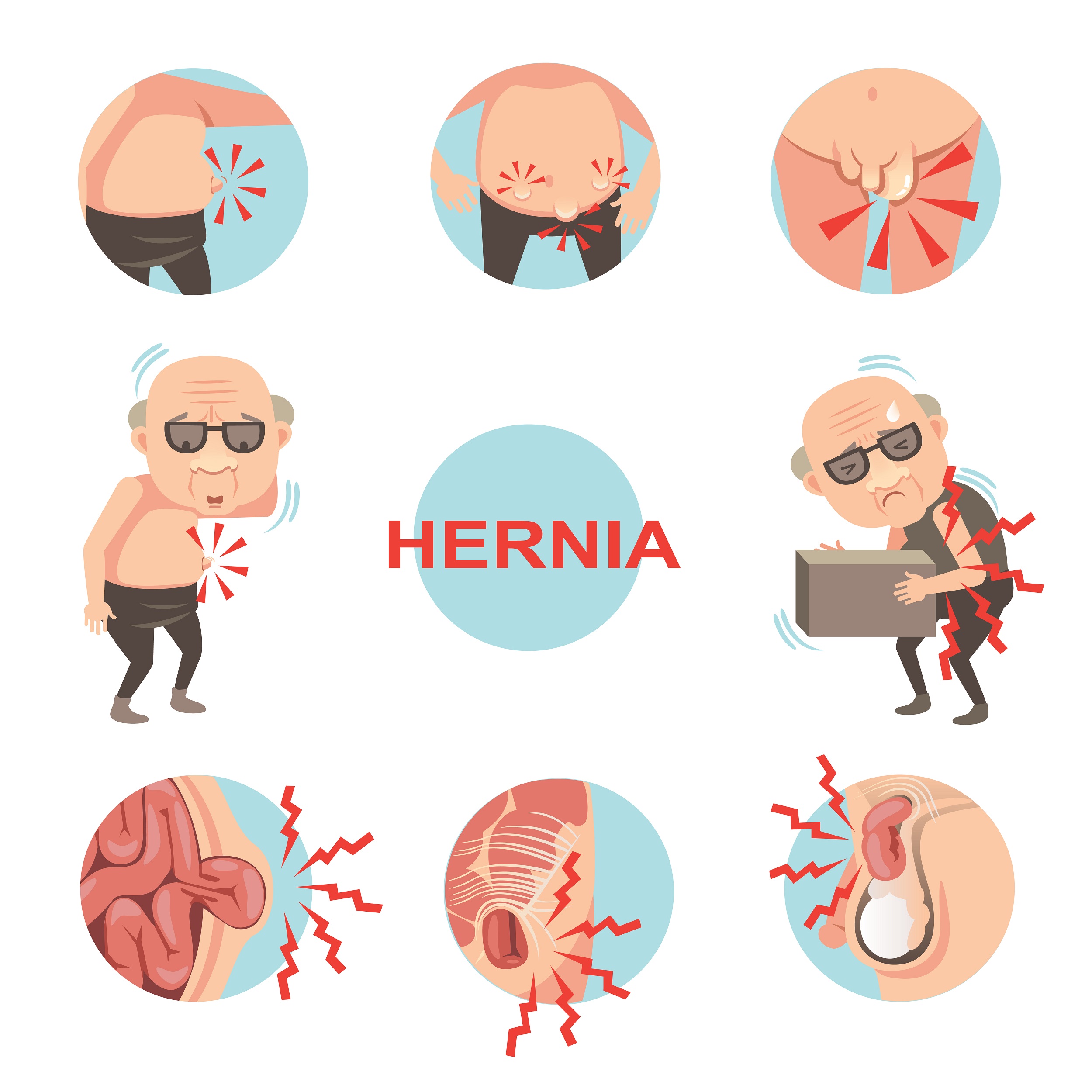 Untreated Hernias are More Dangerous Than You Think!