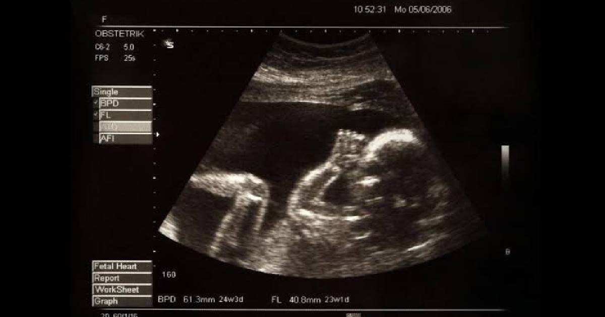  pre-abortion ultrasound 