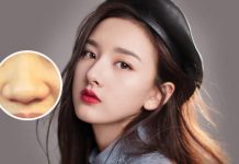 thu nhỏ cánh mũi có vĩnh viễn không