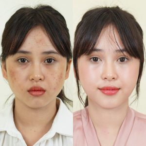 cơ sở trị mụn uy tín Hà Nội