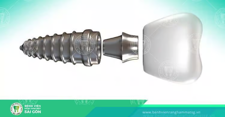 Trồng răng Implant có đau không