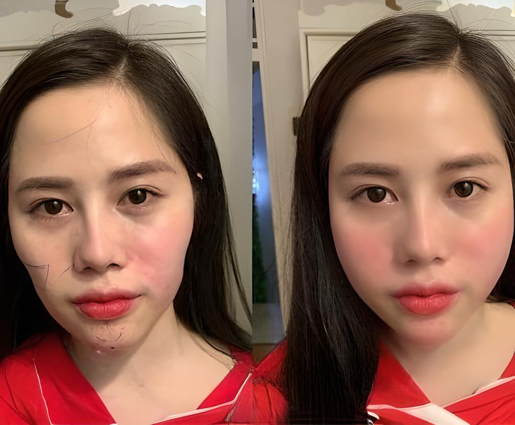 Tiêm Filler Đà Nẵng