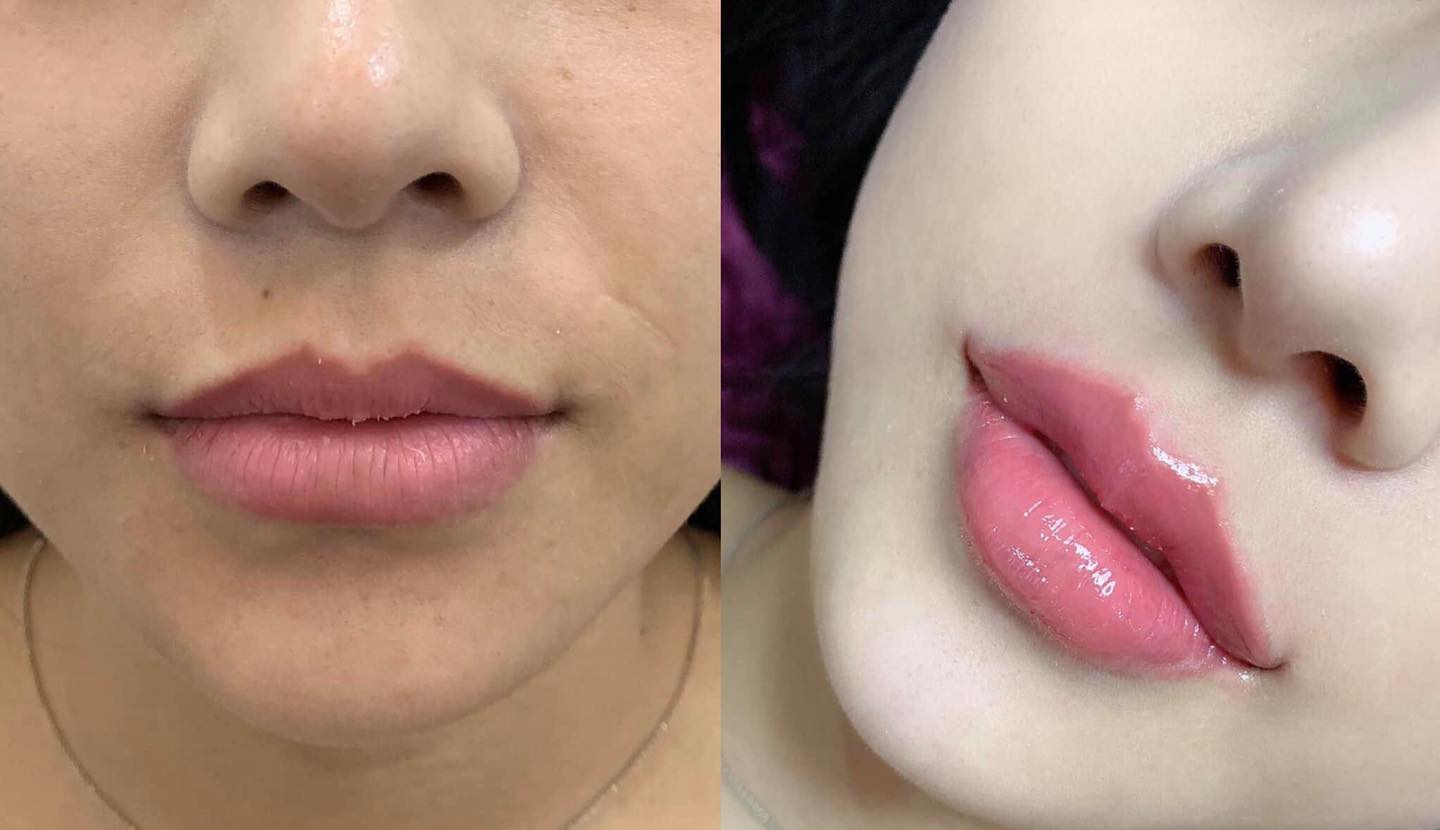 tiêm filler Đà Nẵng