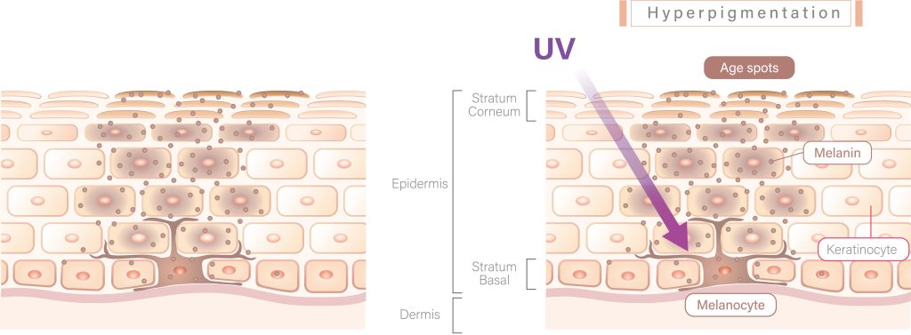 Skin structure illustration of hyperpigmentation and melanocyte with/without explanation
