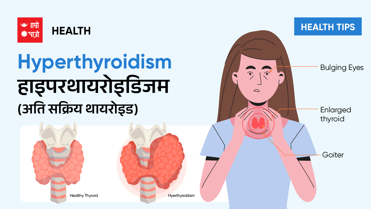 Hyperthyroidism Ati Sakriya Thyroid Hamro Patro