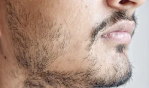 Why do you have a patchy beard?