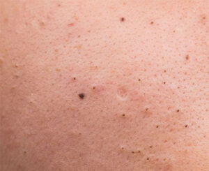 Blackheads