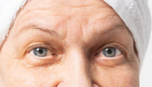 Why Under-eye Bags Appear When You Get Older