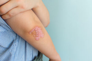 Medical Conditions: Psoriasis