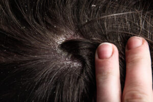 What Causes a Dry Scalp?