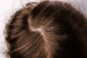 Differences Between Dandruff and a Dry Scalp