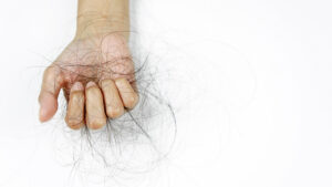 A hand holding hair loss due to hairstyles and treatments