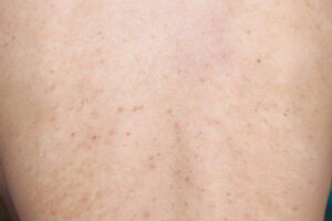 Papules