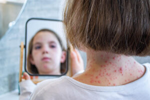 Infections: Chickenpox
