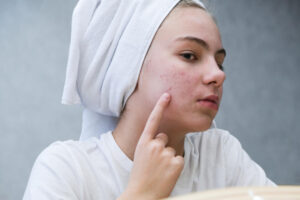 Eliminating Other Factors That Could Impact Your Acne