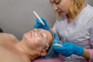 Chemical peels to treat milia