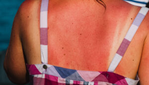 A close up picture of a sunburnt back of a woman