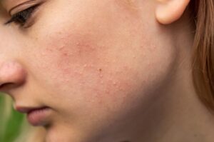 A young girl with a skin problem that is fungal acne