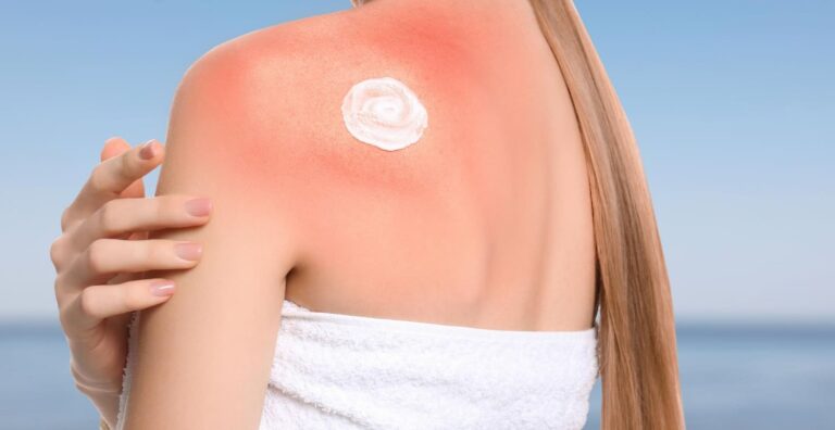 How to Get Rid of Sunburn Fast