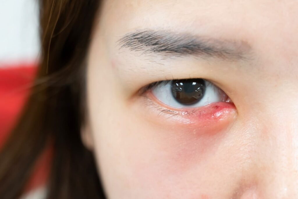 A woman with a pimple on eyelid or eye stye