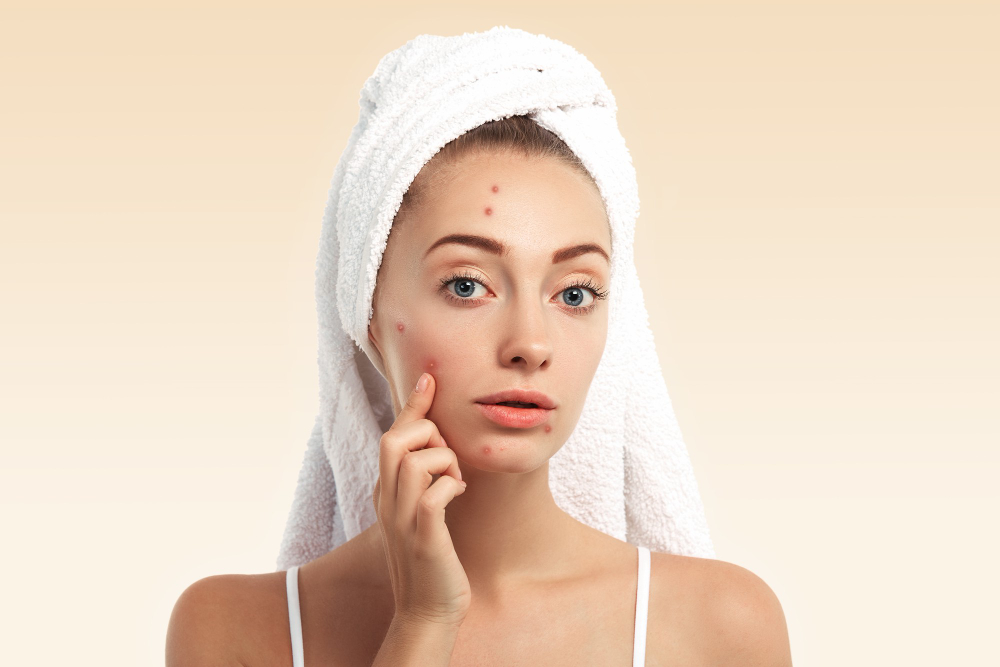 Cystic Acne Treatments