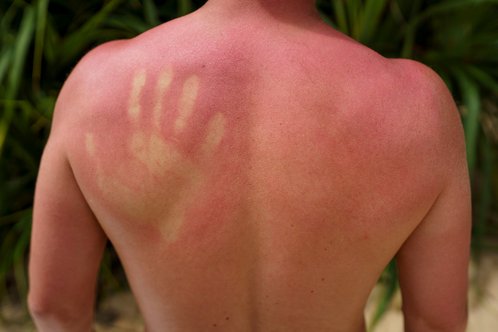 The Symptoms of Sun Poisoning 