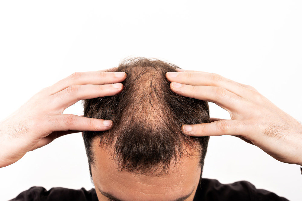 Common cause hair loss