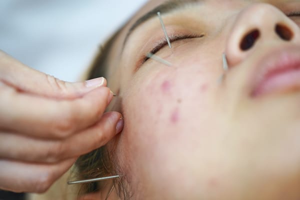 TCM Facial Acupuncture Trial