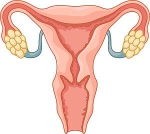 endometriosis