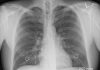 Indonesia’s TB cases drops by 30 percent in January-June 2020