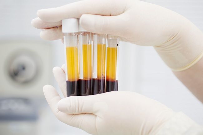 COVID-19 – Lebih 10.000 pasien di Rusia terima plasma darah dengan antibodi