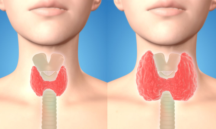 Peneliti China temukan pengobatan baru untuk kanker tiroid