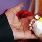 Malnutrisi akut di Yaman