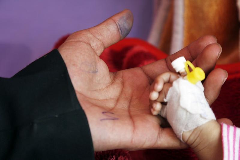 Malnutrisi akut di Yaman