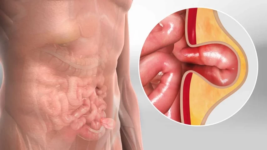 Mengenal Hernia Umbilikalis: Benjolan yang Sering Muncul di Pusar