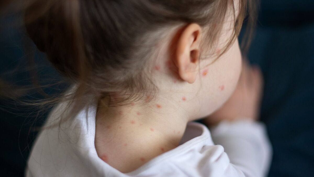 Wales Issues Urgent Call for MMR Vaccines in Children Amid Measles Outbreak