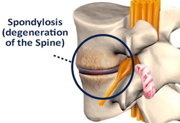 Spondylosis (degradation of the spine)