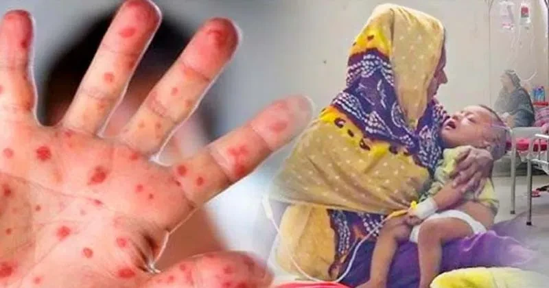 হাম উপসর্গে আরও ২ জনের মৃত্যু, ২৪ ঘণ্টায় ভর্তি ১৩৭৭