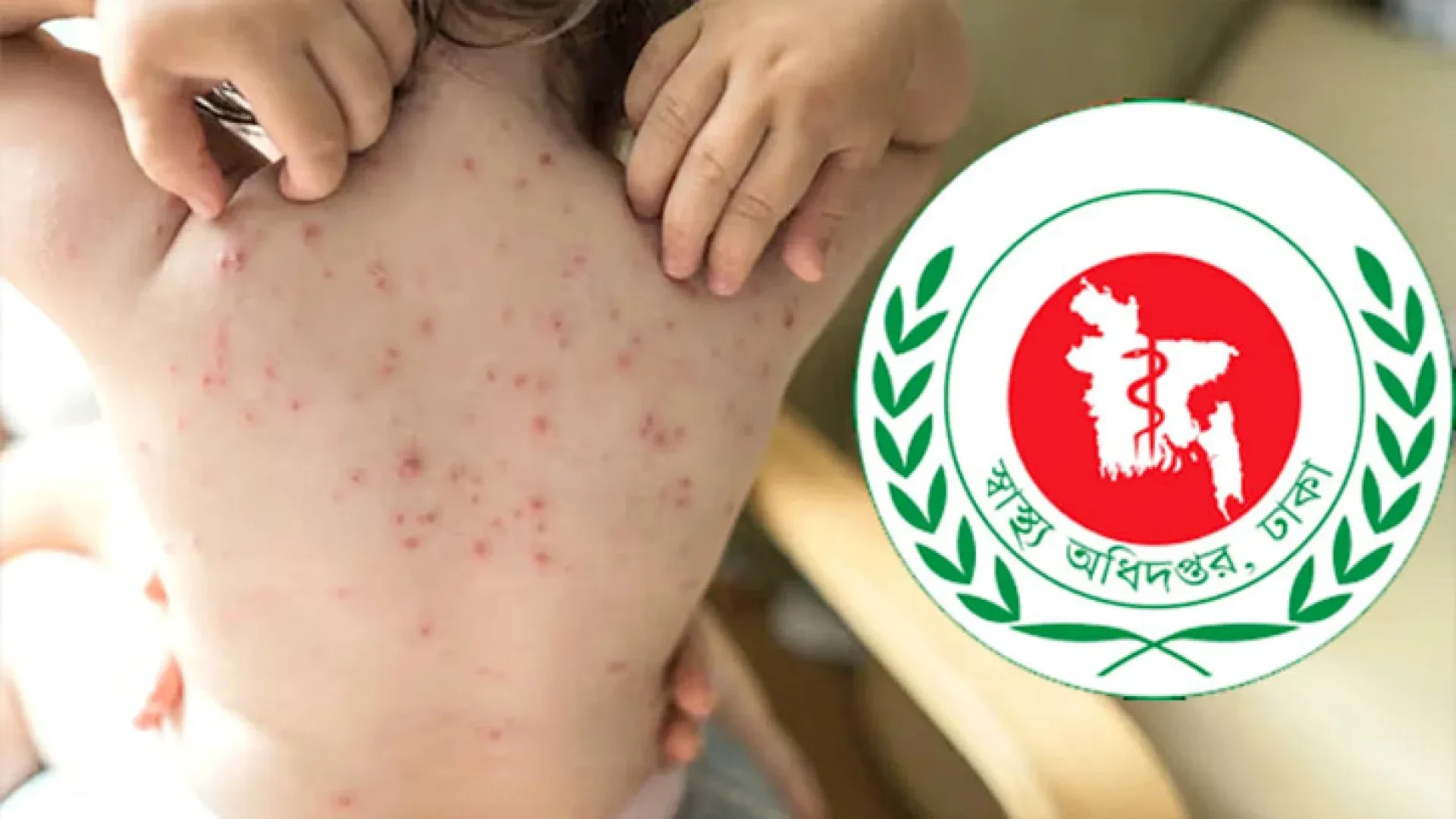 ২৪ ঘণ্টায় হাম ও উপসর্গে ৪ শিশুর মৃত্যু