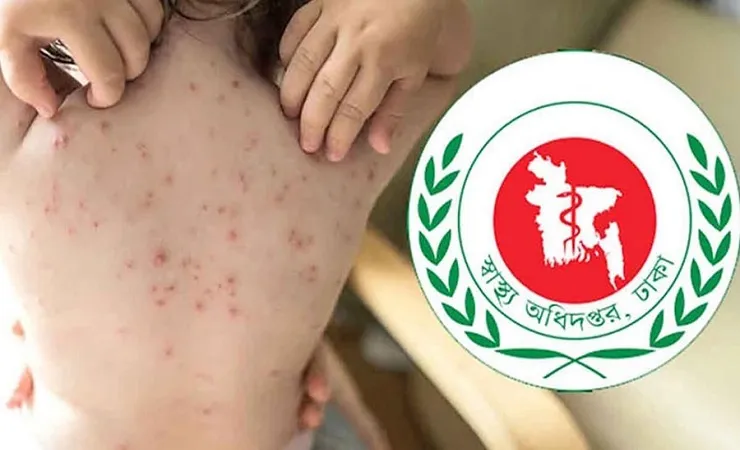 হামে আরও ৪ শিশুর মৃত্যু, ২৪ ঘণ্টায় আক্রান্ত ৭৭৩