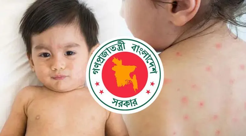 হামের উপসর্গে আরও ৪ শিশুর মৃত্যু, ২৪ ঘণ্টায় আক্রান্ত ৭৭৩ শিশু