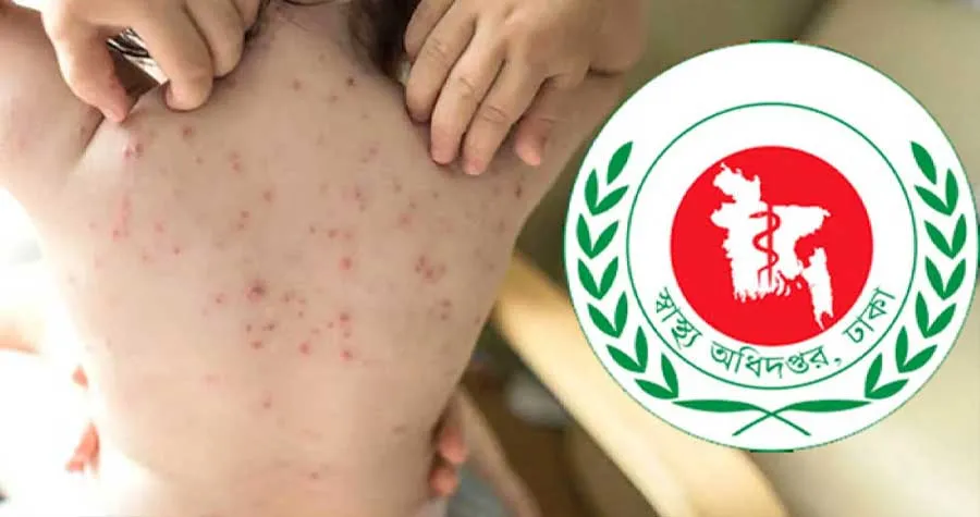 হাম উপসর্গে আরও ৮ শিশুর মৃত্যু