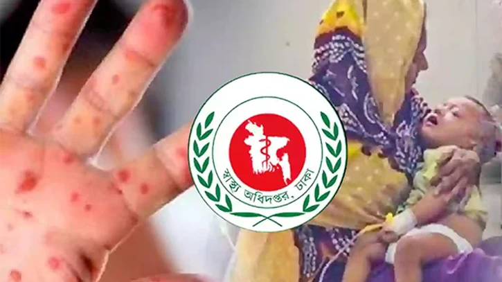 দেশে ২৪ ঘণ্টায় হামে আরও ৫ শিশুর মৃত্যু