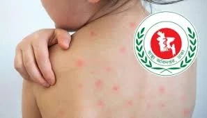 হাম ও উপসর্গে আরও ৮ শিশুর মৃ'ত্যু