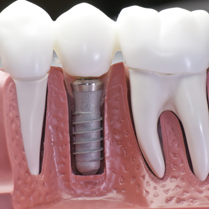 cấy răng implant