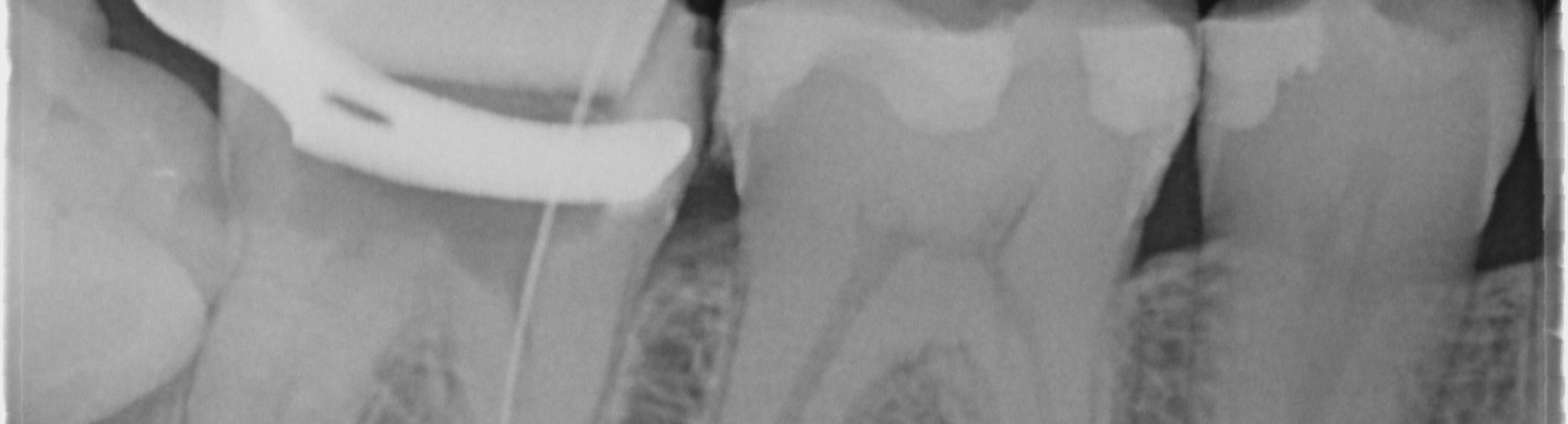 broken-file-in-root-canal-during-root-canal-treatment