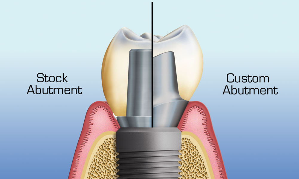 Stock Abutment Vs CAD/CAM Customized Abutment