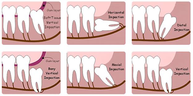 How Much Does Impacted Wisdom Tooth Extraction Cost