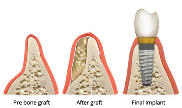 Bone Grafting