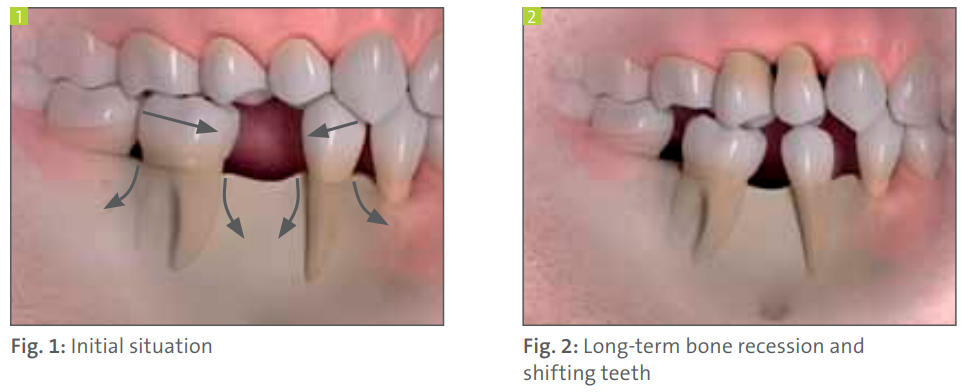 effects of missing teeth